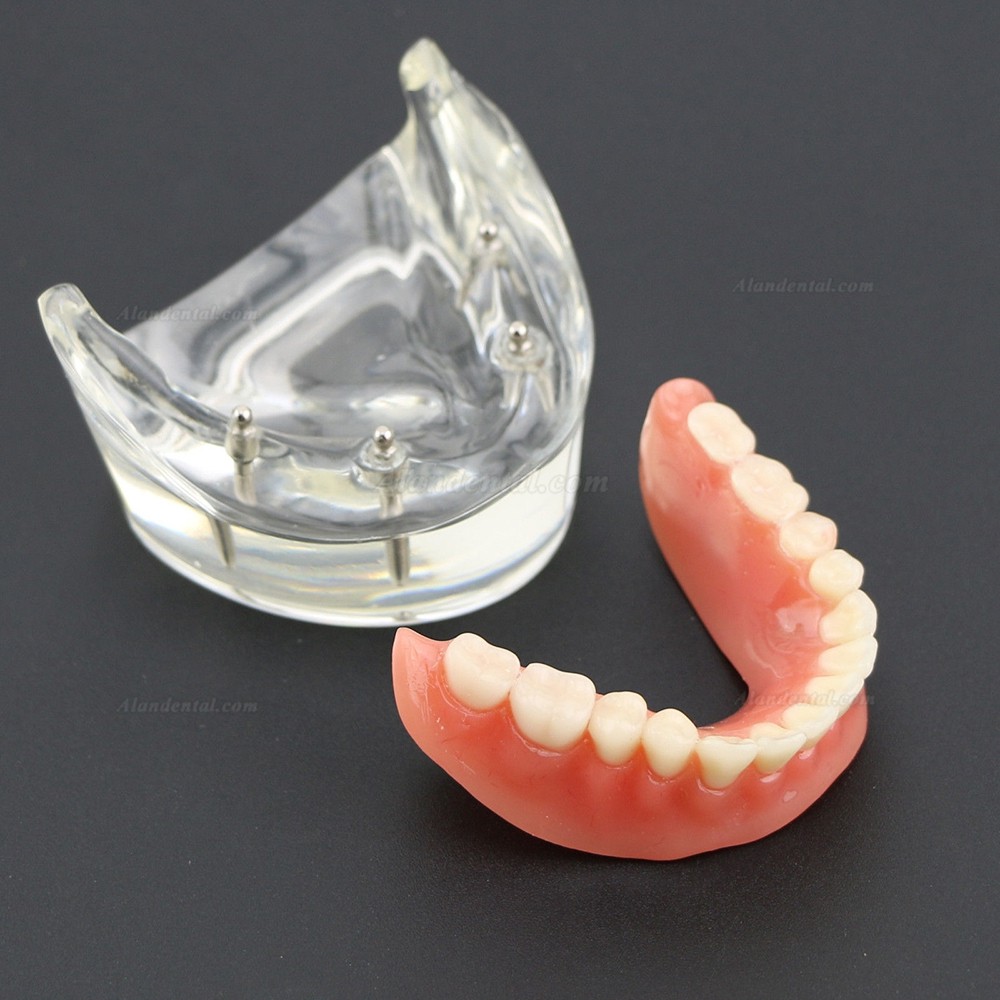 Dental Lower Teeth Demo Study Model 6002 02 Overdenture Inferior 4 Implants